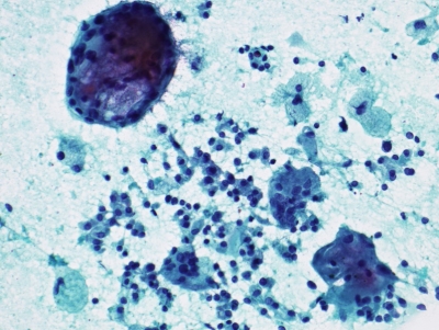 Benign follicular cells.
Keywords: Benign Follicular Cells