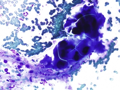 Abundant thick colloid.
Keywords: Abundant Thick Colloid