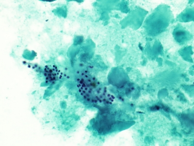 Benign follicular cells and colloid.
Keywords: Benign follicular cells and colloid
