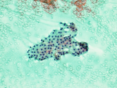 Benign follicular cells (macrofollicular fragment) and colloid.
