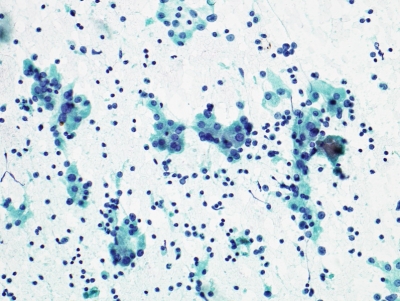 Lymphocytes and Hurthle cells/oncocytic metaplasia
Keywords: Hashimoto's, Chronic Lymphocytic Thyroditis