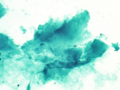 Abundant thick colloid.
Keywords: Abundant Thick Colloid