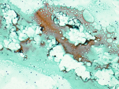 Abundant colloid with bubble artifact.
Keywords: Abundant Colloid, Bubble Artifact