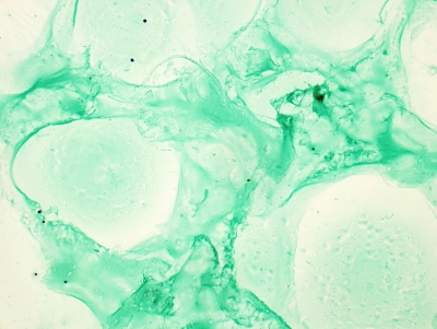 Abundant colloid (Papanicolaou stain).
Keywords: Abundant Colloid