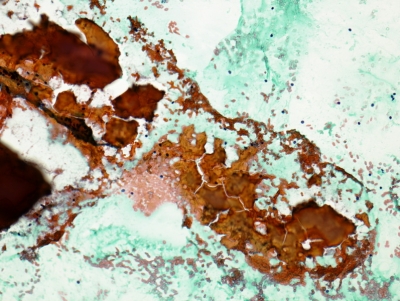 Colloid mixed with blood.
Keywords: Colloid, Blood