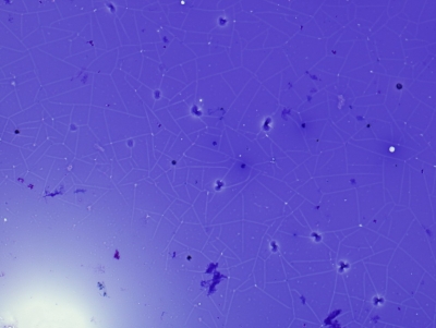 Abundant colloid with "pavementing" ("cracking," "windowpane") artifact.
Keywords: Abundant Colloid, Pavementing, Cracking, Window Pane Artifact