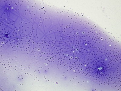 Abundant colloid with "pavementing" ("cracking," "windowpane") artifact.
Keywords: Abundant Colloid with "Pavementing" (Cracking, Window Pane Artifact)
