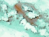 Filename=colloid_nodule-Watery_colloid-pap-low-zhang.jpg
Filesize=213KiB
Dimensions=797x600
Date added=Sep 04, 2009 colloid_nodule-Watery_colloid-pap-low-zhang.jpg