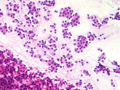 Hurthle cells (oncocytes).
Keywords: Hurthle Cell Adenoma, Follicular Adenoma