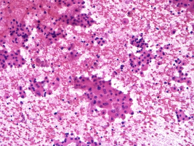 Hurthle cells: single cells and fragments.
Keywords: Hurthle Cell Adenoma, Follicular Adenoma