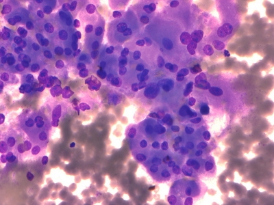 Hurthle cells (oncocytes).
Keywords: Hurthle Cell Adenoma, Follicular Adenoma