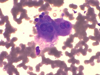 Hurthle cells (oncocytes).
Keywords: Hurthle Cell Adenoma, Follicular Adenoma, Oncocytes, Hurthle Cells
