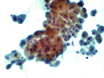 Hurthle cells (oncocytes).
Keywords: Hurthle Cell Adenoma, Follicular Adenoma