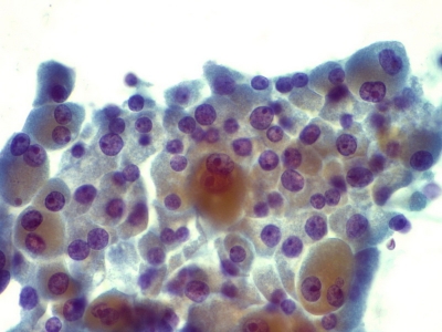 Hurthle cells (oncocytes).
Keywords: Hurthle Cell Adenoma, Follicular Adenoma