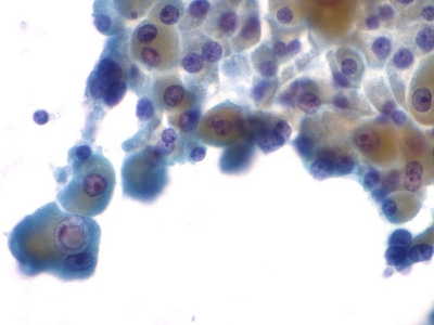 Hurthle cells (oncocytes).
Keywords: Hurthle Cell Adenoma, Folllicular Adenoma, Follicular Neoplasm