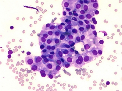 Hurthle cells (oncocytes).
Keywords: Hurthle Cell Adenoma, Folllicular Adenoma, Follicular Neoplasm