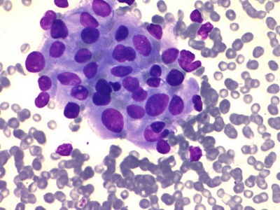Hurthle cells with variation in nuclear size and shape.
Keywords: Hurthle Cell Adenoma, Folllicular Adenoma, Follicular Neoplasm