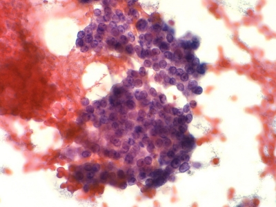 Marked follicular cell crowding.
Keywords: Hurthle Cell Adenoma, Folllicular Adenoma, Follicular Neoplasm