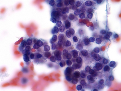 Crowded follicular cells and microfollicle.
Keywords: Hurthle Cell Adenoma, Folllicular Adenoma, Follicular Neoplasm