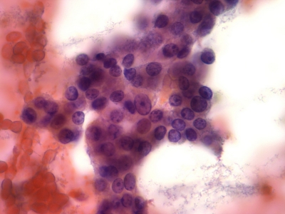 Crowded follicular cells.
Keywords: Folllicular Adenoma, Follicular Neoplasm