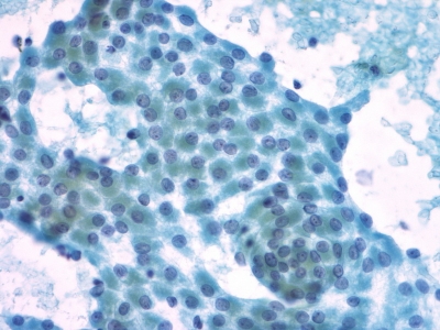 Hurthle cells (oncocytes).
Keywords: Hurthle Cell Adenoma, Folllicular Adenoma, Follicular Neoplasm