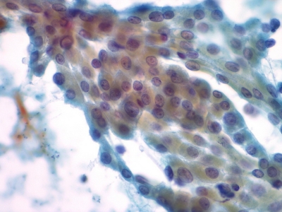 Hurthle cells (oncocytes).
Keywords: Hurthle Cell Adenoma, Folllicular Adenoma, Follicular Neoplasm