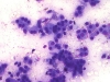 Filename=follicular_neoplasm_hurthle_cell_type-fu_hurthle_cell_adenoma-dq6-high-sturgis.jpg
Filesize=174KiB
Dimensions=800x600
Date added=Sep 04, 2009 follicular_neoplasm_hurthle_cell_type-fu_hurthle_cell_adenoma-dq6-high-sturgis.jpg