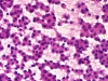 Filename=follicular_neoplasm_hurthle_cell_type-fu_hurthle_cell_adenoma2-_H_E-high-sturgis.jpg
Filesize=249KiB
Dimensions=800x600
Date added=Sep 04, 2009 follicular_neoplasm_hurthle_cell_type-fu_hurthle_cell_adenoma2-_H_E-high-sturgis.jpg