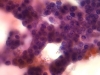 Filename=follicular_neoplasm_hurthle_cell_type-fu_hurthle_cell_carcinoma-pap19b-high-sturgis.jpg
Filesize=118KiB
Dimensions=800x600
Date added=Sep 04, 2009 follicular_neoplasm_hurthle_cell_type-fu_hurthle_cell_carcinoma-pap19b-high-sturgis.jpg