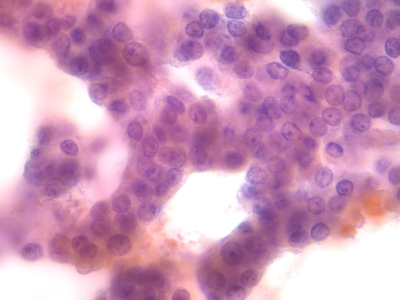 Hurthle Cells
Aggregate of Hurtle cells with trabecular architecture.
Keywords: Hurthle Cells, Hurthle cell neoplasm