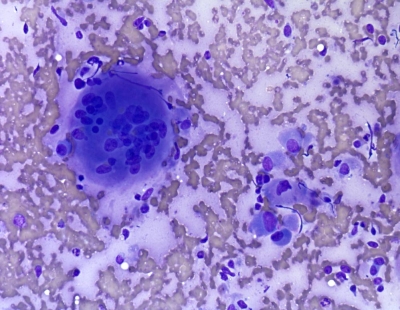 Malignant cells with an osteoclast-type giant cell.
Keywords: Undifferentiated, Anaplastic, Carcinoma