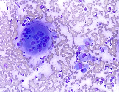 Anaplastic Carcinoma of Thyroid
A large inflammatory type giant cell found in a case of anaplastic carcinoma of the thryoid.
Keywords: Anaplastic Carcinoma