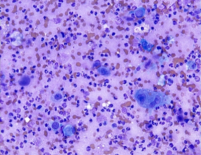 Pleomorphic cells with necrosis.
Keywords: Undifferentiated, Anaplastic, Carcinoma