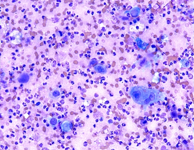 Anaplastic Carcinoma of Thyroid
Intermediate power image of anaplastic carcinoma.
Keywords: Anaplastic Carcinoma