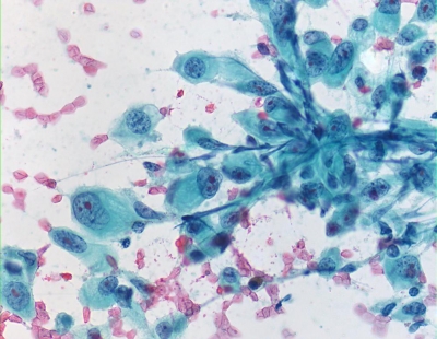 Large malignant cells.
Keywords: Undifferentiated, Anaplastic, Carcinoma