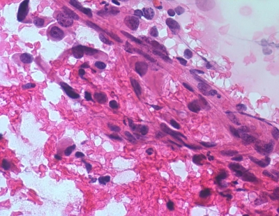 Malignant cells and blood (H&E).
Keywords: Undifferentiated, Anaplastic, Carcinoma