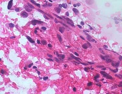 Anaplastic Carcinoma of Thyroid
Spindle cells in a portion of anaplastic carcinoma of thyroid.
Keywords: Anaplastic Carcinoma