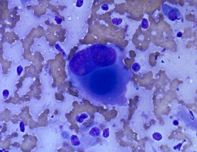 Giant tumor cell with rhabdoid appearance.
Keywords: Undifferentiated, Anaplastic, Carcinoma