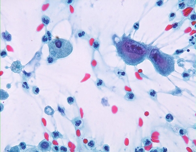 A pair of malignant cells admixed with macrophages and neutrophils.
Keywords: Undifferentiated, Anaplastic, Carcinoma