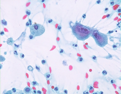 Anaplastic Carcinoma of Thyroid
Tumor giant cells 
Keywords: Anaplastic Carcinoma