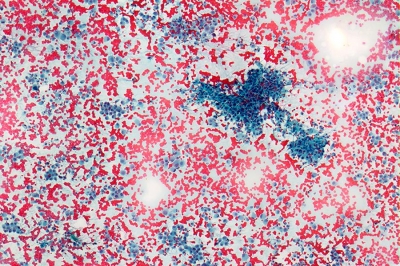 Cellular sample with numerous non-cohesive cells.
Keywords: undifferentiated, Anaplastic, Carcinoma