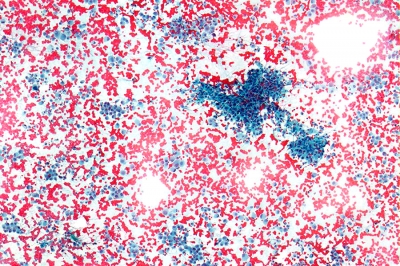 Anaplastic Carcinoma of Thyroid
Low power view of anaplastic carcinoma of thyroid preparation. Note the cellularity.
Keywords: Anaplastic Carcinoma