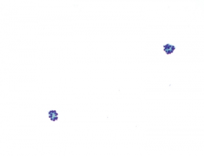 AUS/FLUS.
Sparsely cellular specimen comprised predominantly of microfollicles (ThinPrep®)(scenario 1).
Keywords: AUS, Atypical, Uncertain Significance