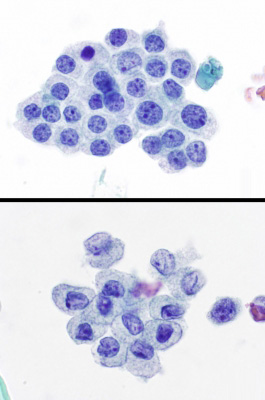 AUS/FLUS.
Most of the specimen is comprised of benign macrofollicles (upper image). Rare groups show nuclear grooves and nuclear profile irregularity (lower image) (Bethesda monograph, pages 38-9: scenario 5).
Keywords: AUS Scenario 5