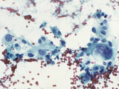 AUS/FLUS.
Atypical cells post radioiodine therapy (Bethesda monograph, pages 38-9: scenario 7a).
Keywords: AUS, FLUS, Atypia, Uncertain, post radioiodine