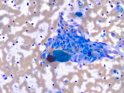 AUS/FLUS.
Crowded, fusiform cyst lining cells with focal nuclear atypia represent the most prominent finding in this specimen (Bethesda monograph, pages 38-9: scenario 6).
Keywords: AUS, Atypical, Uncertain Significance, Adenomatoid Nodule