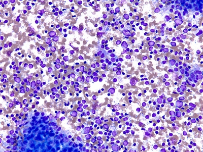 Metastatic Malt Lymphoma
Keywords: Metastatic Malt Lymphoma
