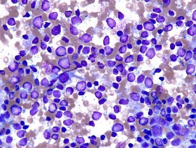 Metastatic Malt Lymphoma
Keywords: Metastatic Malt Lymphoma