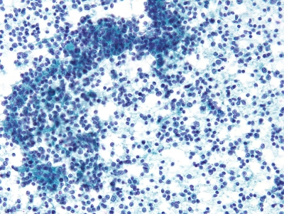 Metastatic Malt Lymphoma
Keywords: Metastatic Malt Lymphoma