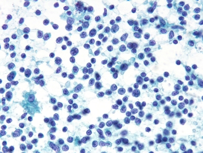 Malt Lymphoma
Keywords: Metastatic Malt Lymphoma